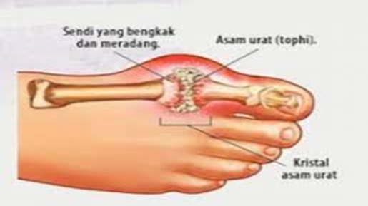 Mengetahui Perbedaan Nyeri Sendi Karena Asam Urat Atau Rematik
