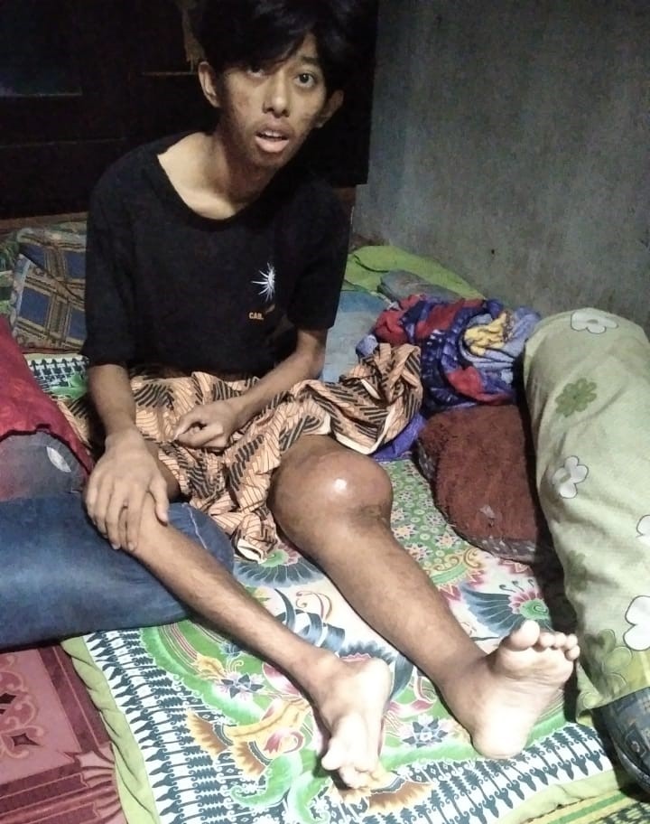 Pelajar SMAN 1 Kota Agung Tanggamus Divonis Kanker, Keluarga Kurang Mampu Butuh Bantuan Pelajar SMAN 1 Kota Agung Tanggamus Divonis Kanker, Keluarga Kurang Mampu Butuh Bantuan